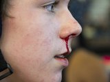 ako zastaviť krvácanie z nosa