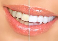 bielenie zubov pomocou bieliacích pásikov
