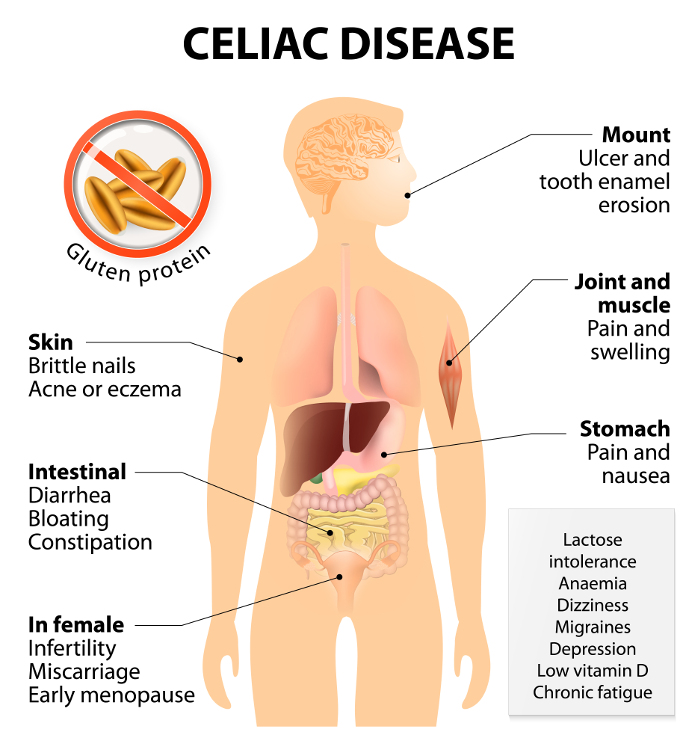 Zdravotné príznaky a riziká Celiakie